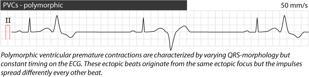 Figure 4. Complexes ventriculaires prématurés polymorphes (contractions).
