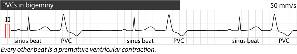 Figure 3. Contractions ventriculaires prématurées en bigéminisme.