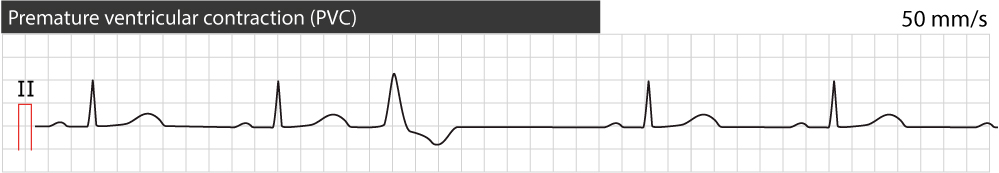 Figure 1. Contraction ventriculaire prématurée (complexe/battement). Aspect typique. Notez que la vitesse du papier est de 50 mm/s (1 grande case équivaut à 100 ms).