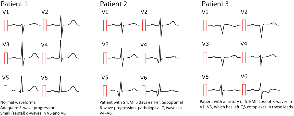 Figure 12. Ondes Q normales et pathologiques