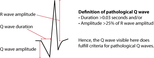 Figure 11. Critères pour les ondes Q pathologiques