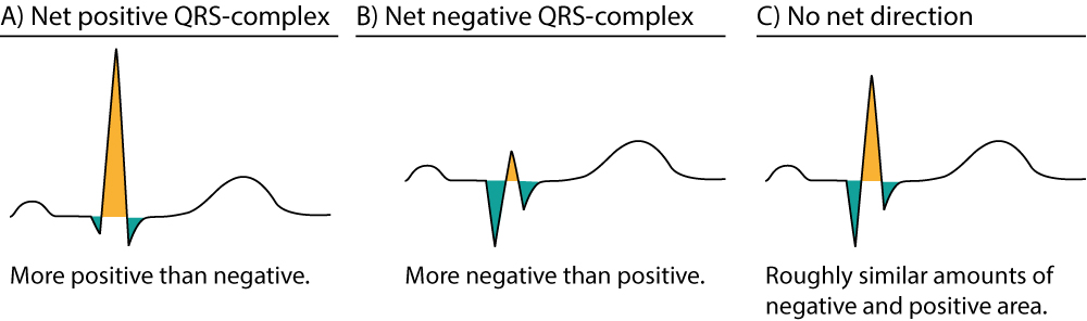 Figure 6. Approximations de la direction nette du complexe QRS. Les zones positives sont en jaune et les zones négatives en vert