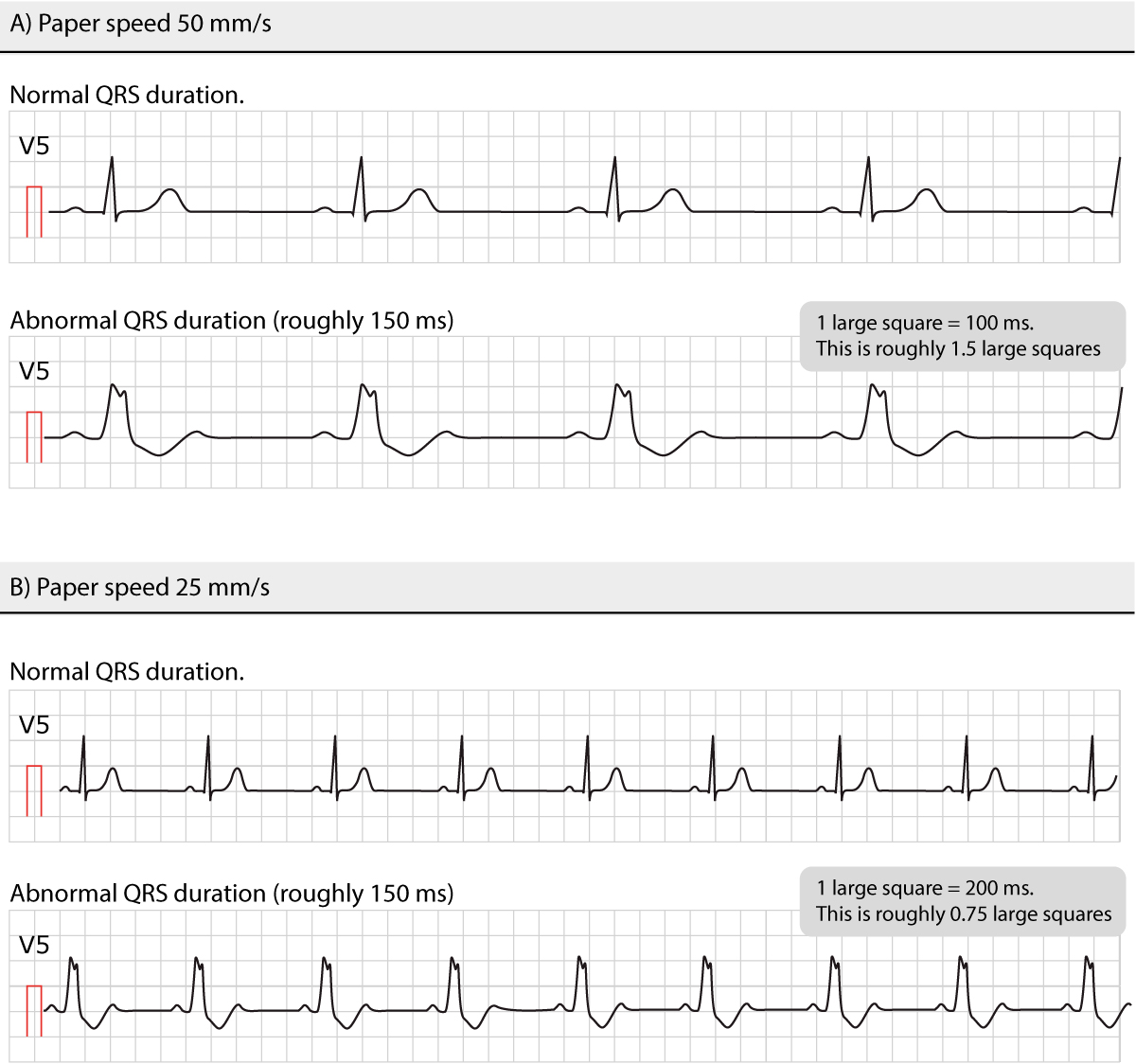 Figure 8. Durées normales et anormales des QRS à différentes vitesses de papier