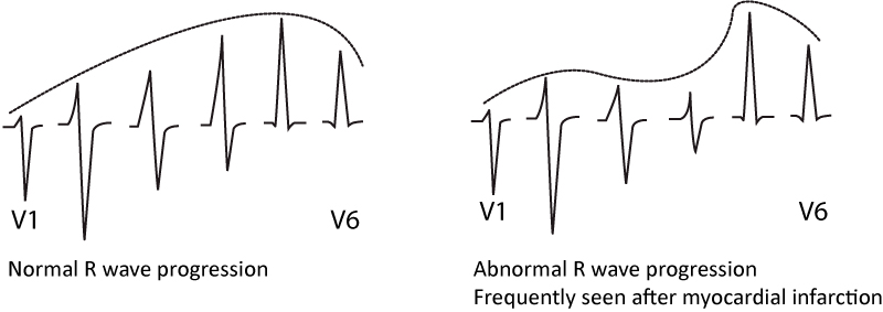 Figure 10. Progression normale et anormale de l'onde R