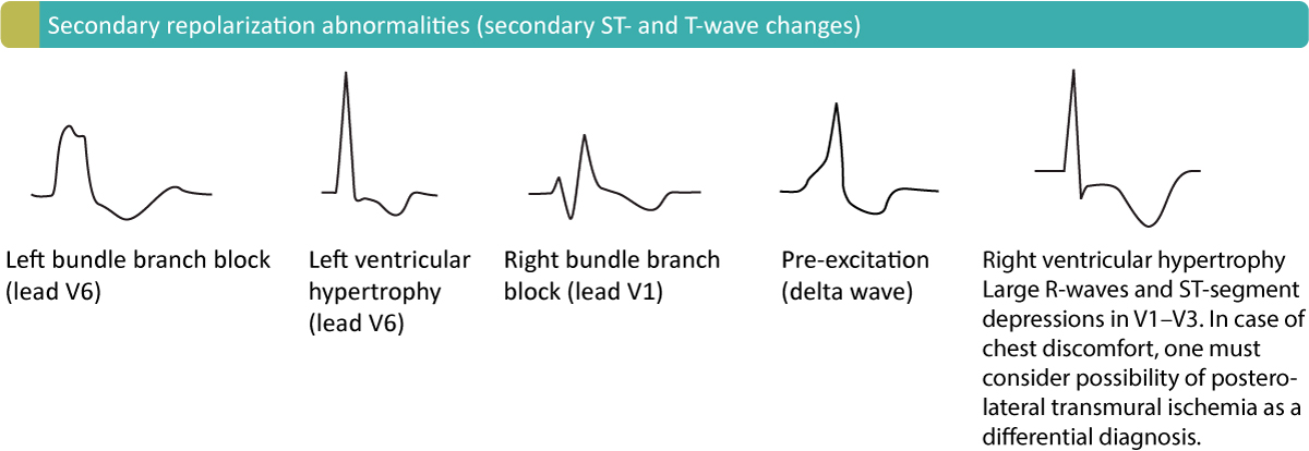 Figure 19. Inversions secondaires de l'onde T