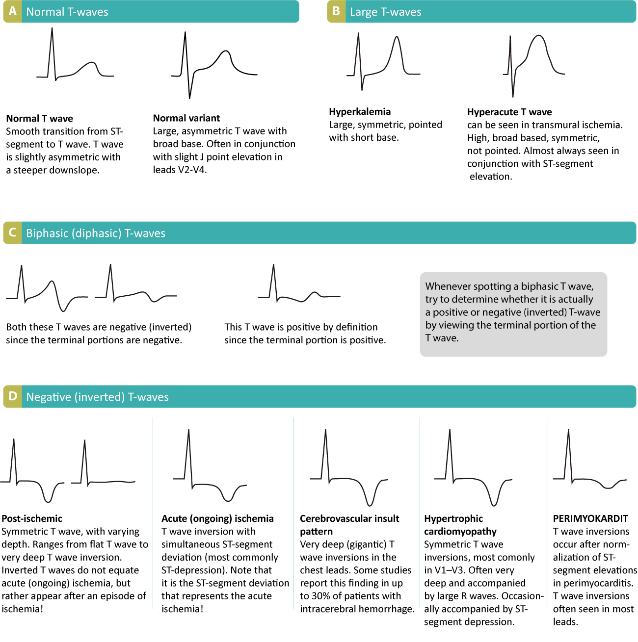 Figure 18. Ondes T normales et pathologiques