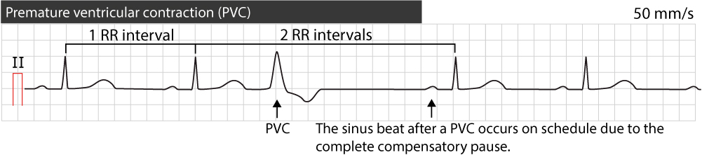 Figure 2. Pause compensatoire complète après une contraction ventriculaire prématurée.