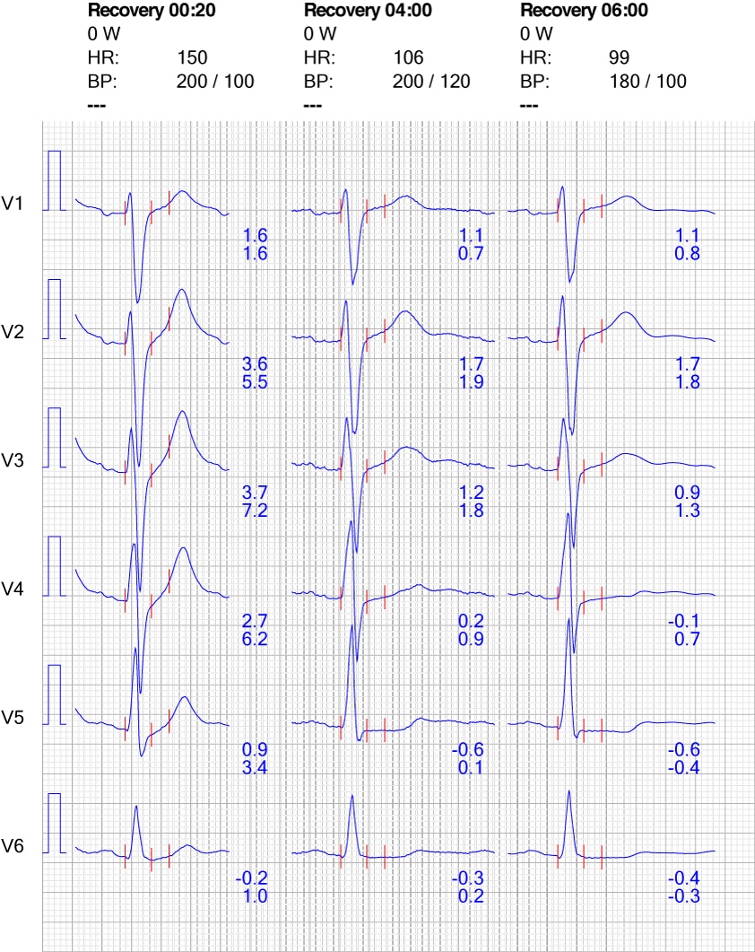 Figure 10. Réaction de l'ECG dans les dérivations thoraciques pendant la récupération.