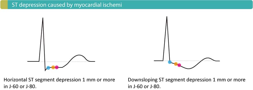 Figure 3. Dépression du segment ST typique d'une ischémie myocardique en cours.