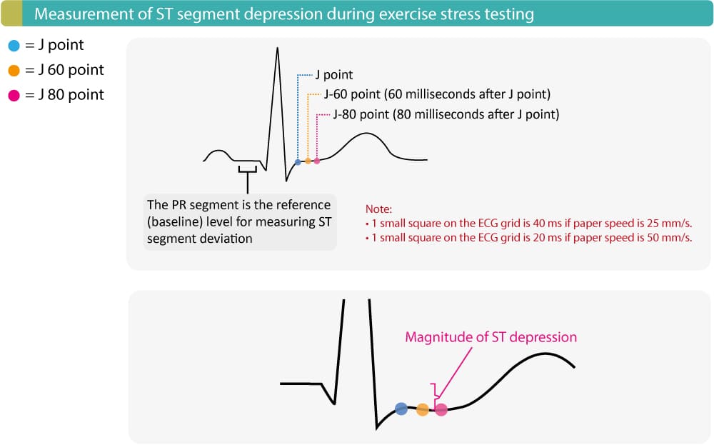Figure 2. Mesure de la dépression du segment ST pendant l’épreuve d’effort.