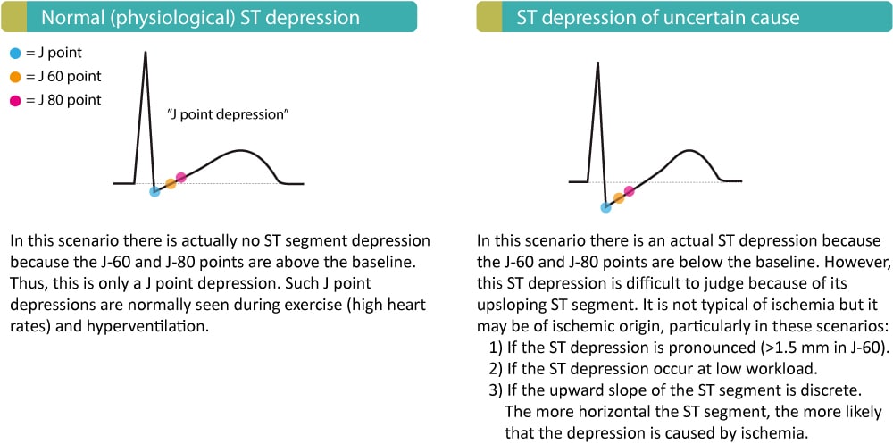 Figure 4. Dépressions du segment ST non typiques de l'ischémie myocardique.