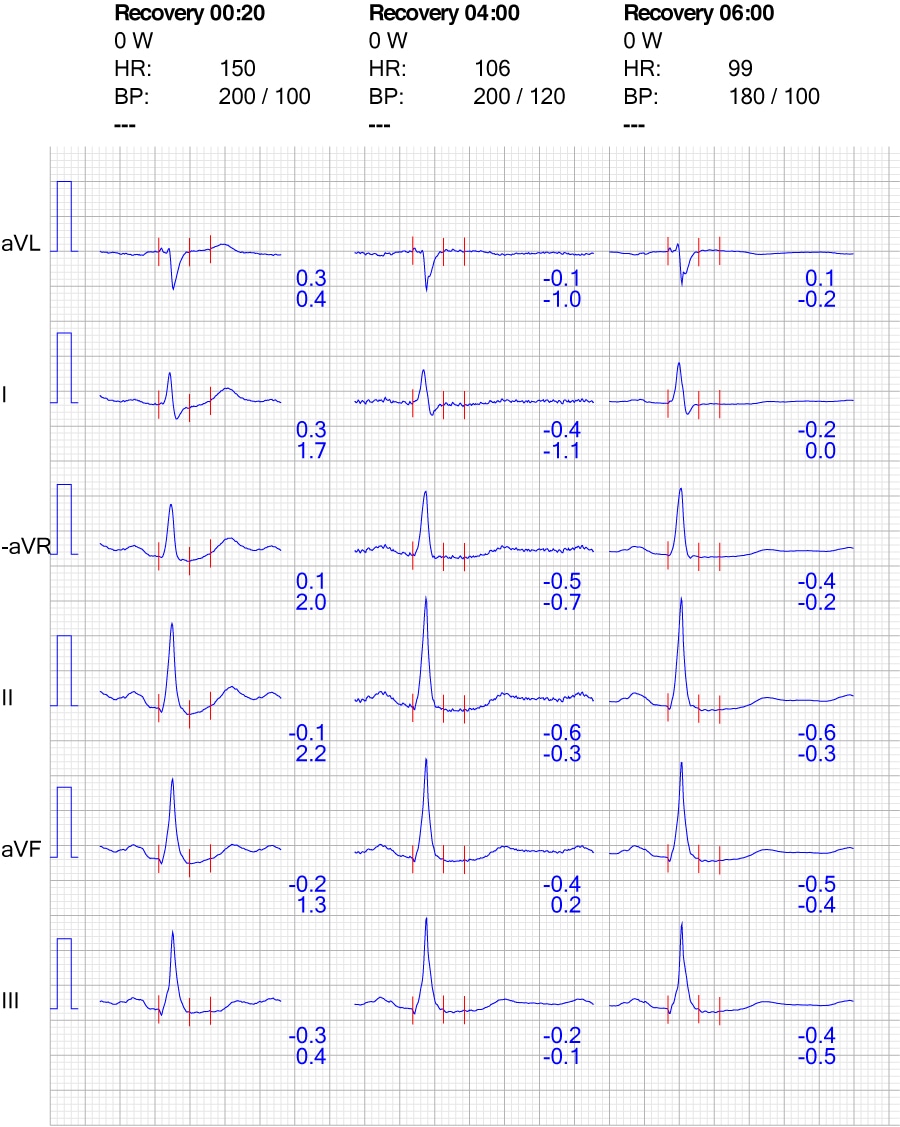 Figure 8. Réaction de l'ECG dans les dérivations des membres pendant la récupération.