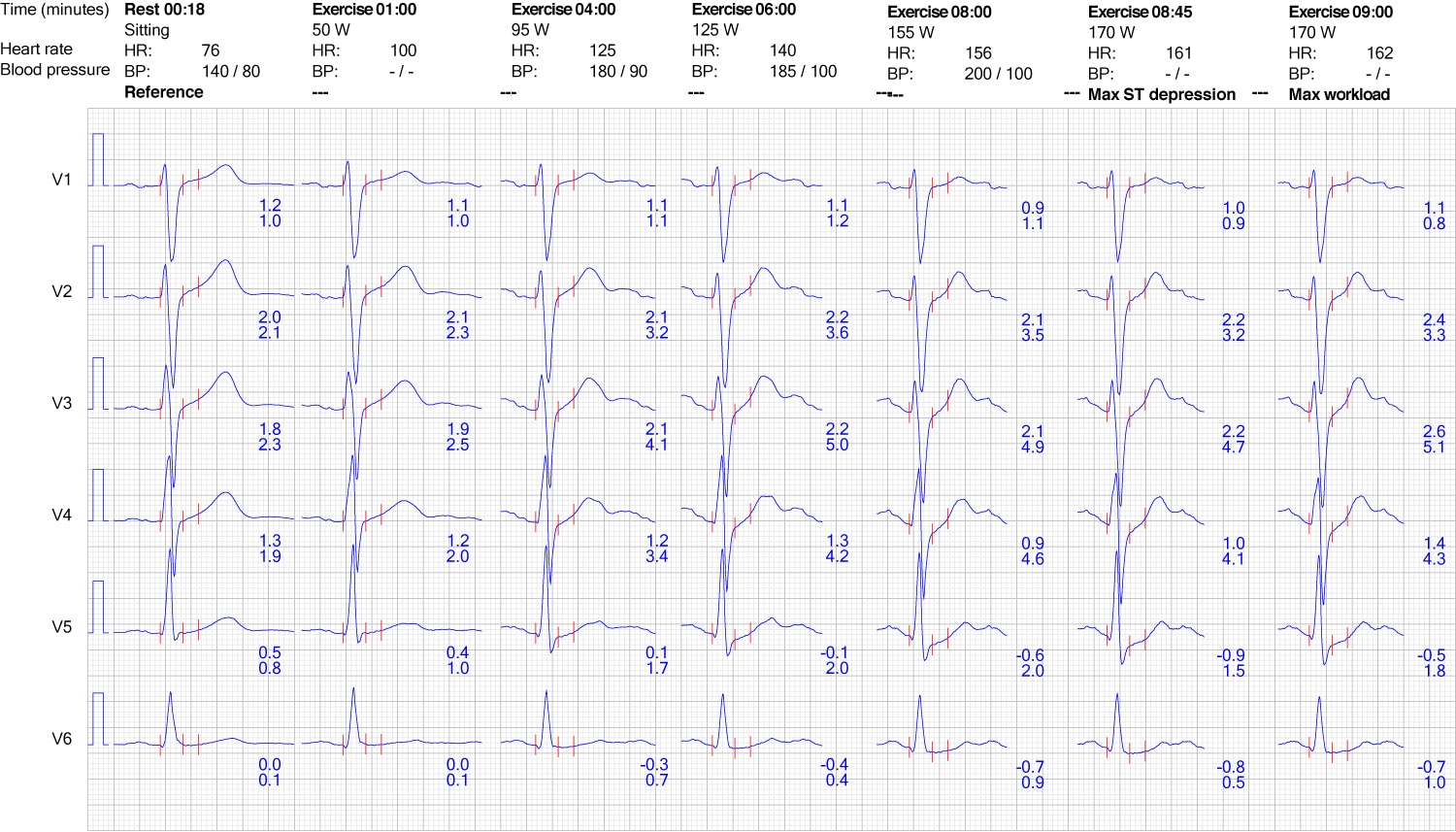 Figure 9. Réaction de l'ECG dans les dérivations thoraciques pendant l'exercice.
