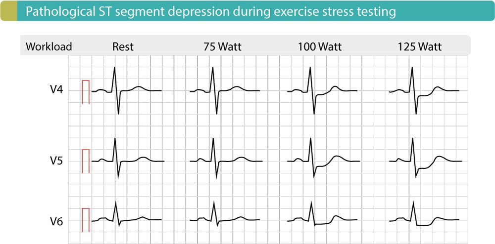 Figure 5. L'ECG d'effort d'un patient atteint d'une maladie coronarienne montre des dépressions ST significatives aux points J-60 et J-80. Ces dépressions deviennent plus prononcées à mesure que la charge de travail augmente. Ce test a été réalisé sur ergocycle.
