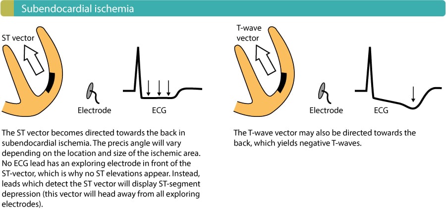 Figure 1. L'exercice physique provoque une ischémie sous-endocardique et donc une dépression du segment ST sur l'ECG.