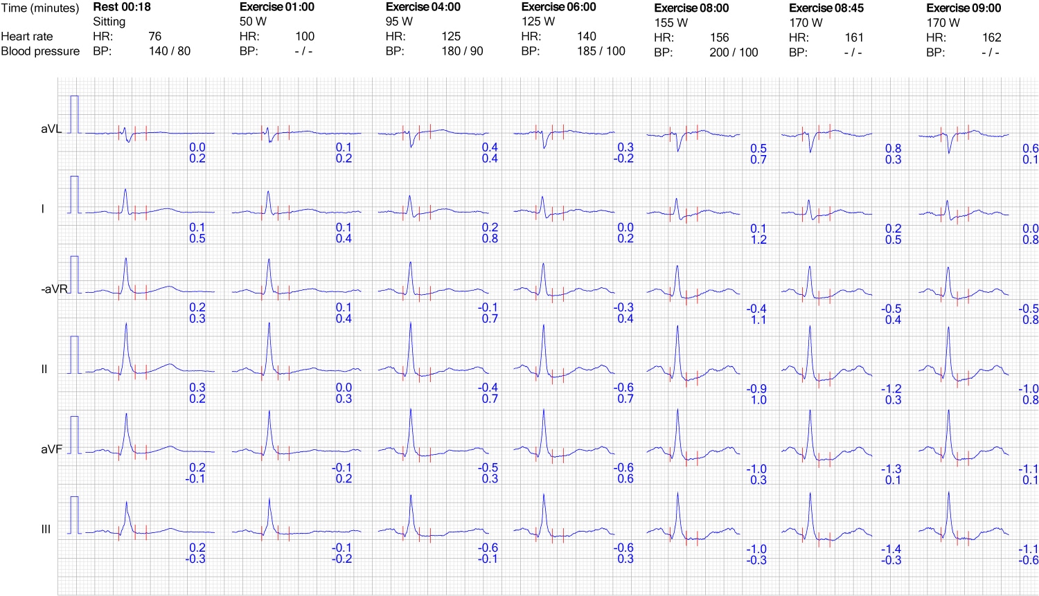 Figure 7. Réaction de l'ECG dans les dérivations des membres pendant l'exercice.