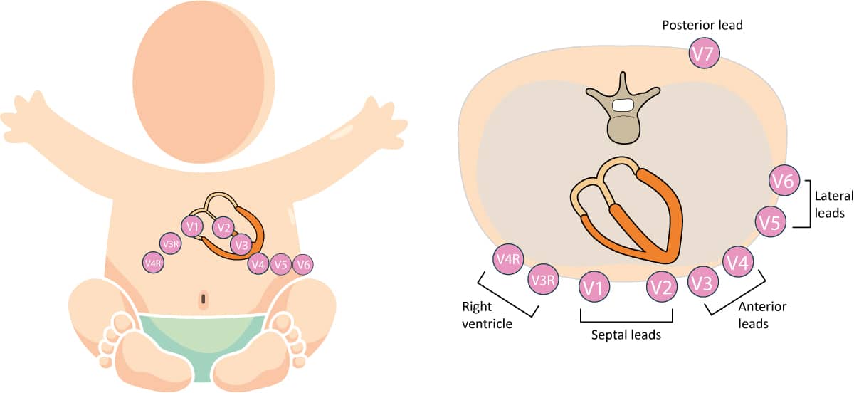 Figure 2. Placement des électrodes thoraciques chez l'enfant