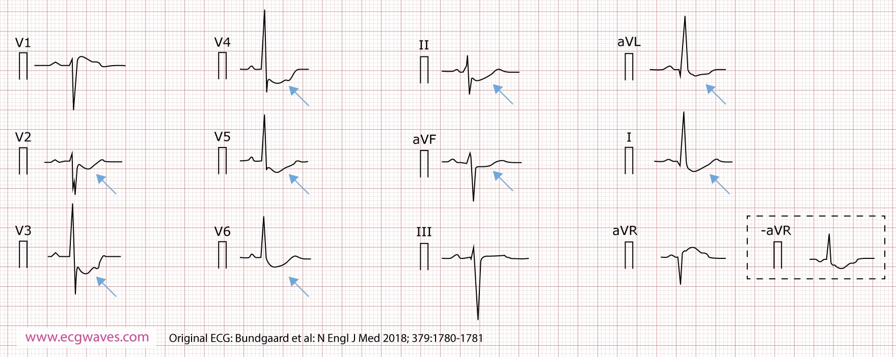 ECG à 12 dérivations (présenté selon Cabrera), enregistré à l'âge de 63 ans, montrant une dépression concave vers le haut du segment ST dans les dérivations I, II, aVL, aVF, et V2 à V6 ; et une élévation du segment ST dans la dérivation aVR (qui correspond à une dépression identique du segment ST dans la dérivation inversée -aVR). Une encoche est évidente dans la partie ascendante du segment ST.