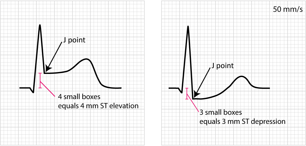 Figure 2. Exemples de mesure du sus-décalage et du sous-décalage du segment ST. Une ischémie myocardique est très probable si ces modifications de l’ECG s’accompagnent d’une gêne thoracique ou d’autres symptômes évocateurs d’une ischémie.