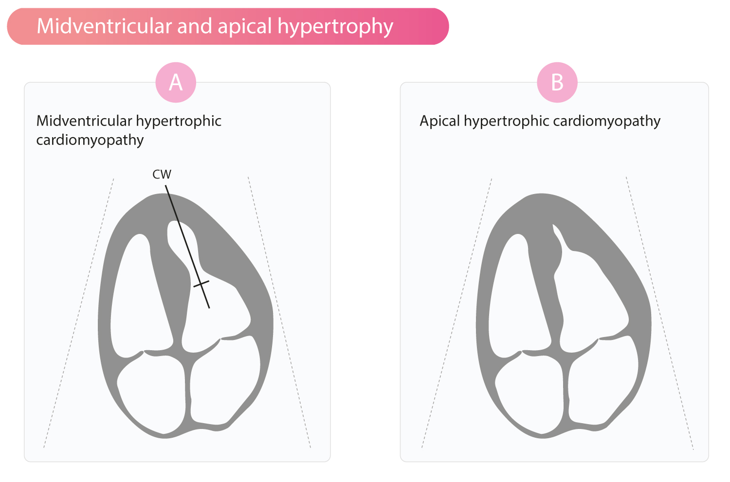 Figure 4. (A) CMH médio-ventriculaire avec gradient intra-cavitaire. (B) CMH Apicale donnant la forme caractéristique en "As de pique".