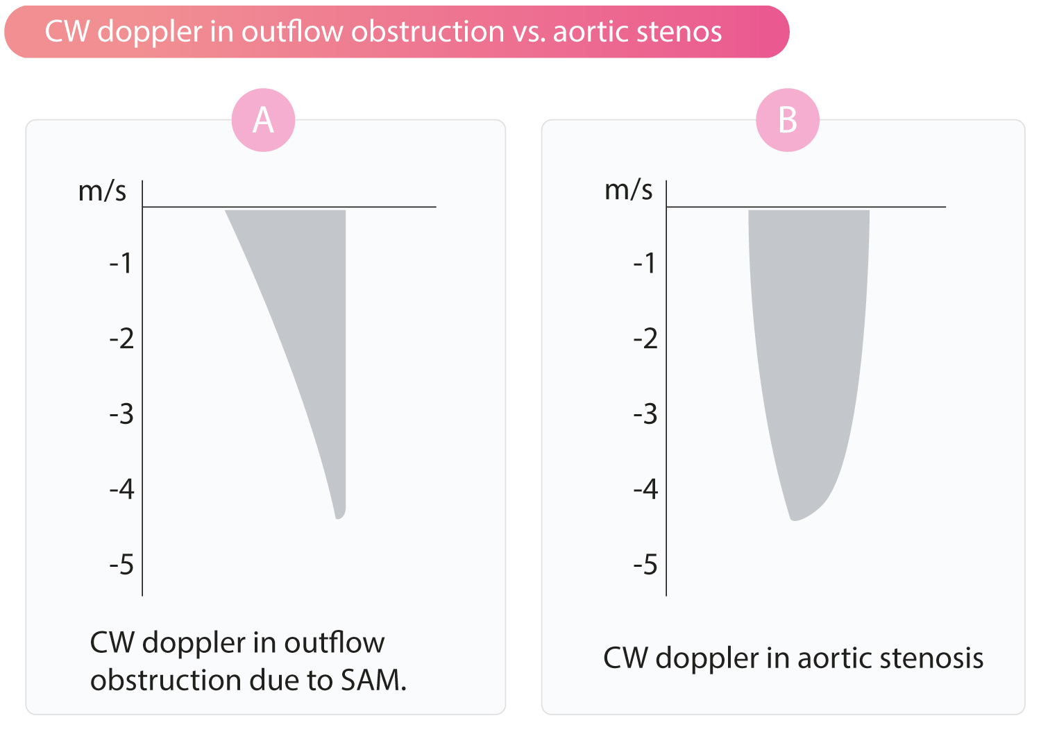 Figure 3. Doppler à onde continue dans le LVOT. (A) Profil en "lame de sabre" caractéristique de l'obstruction dynamique (SAM) avec un pic tardif télé-systolique. (B) Profil en dôme symétrique typique de la sténose aortique fixe.