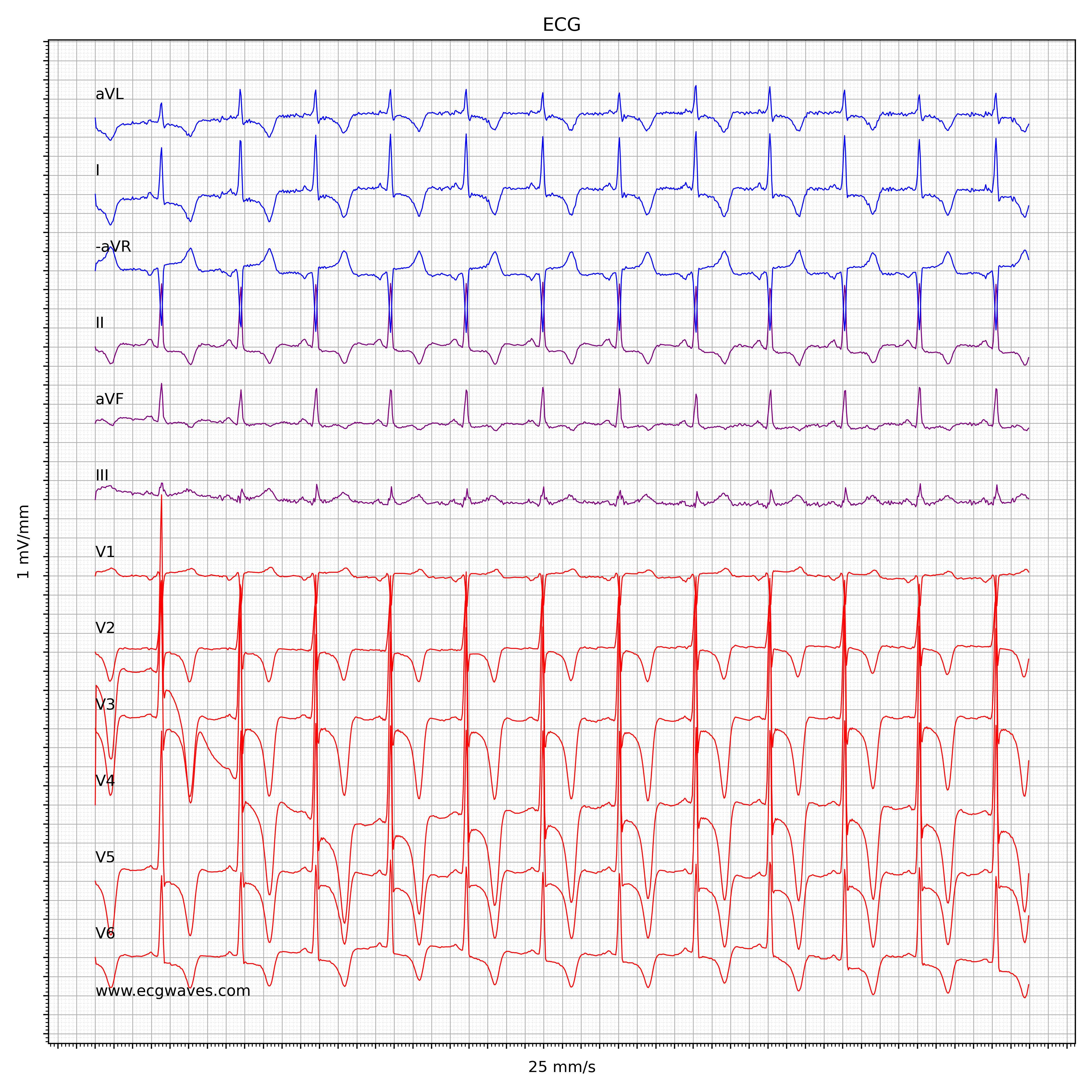 ECG en cas de cardiomyopathie hypertrophique obstructive (CMH, CMHO)