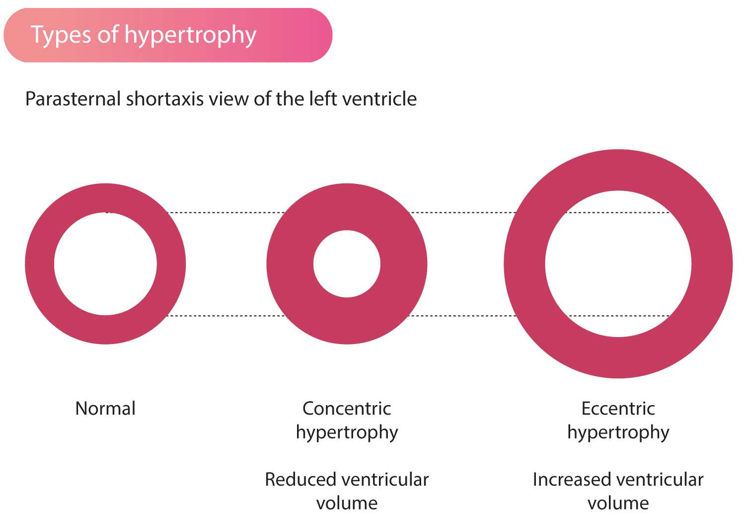 Figure 1. Types d'hypertrophie ventriculaire gauche. Le volume de la cavité ventriculaire gauche est souvent réduit en cas d'hypertrophie concentrique ou de CMH. L'hypertrophie excentrique (dilatation cavitaire avec paroi épaisse) est rare dans la CMH classique mais peut se voir dans la phase dilatée.
