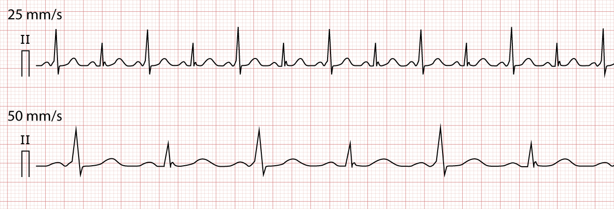Figure 6. Enregistrement ECG montrant un rythme avec conduction d’un battement sur deux par une voie accessoire, entraînant des variations d’amplitude du complexe QRS (alternance électrique par pré-excitation intermittente).
