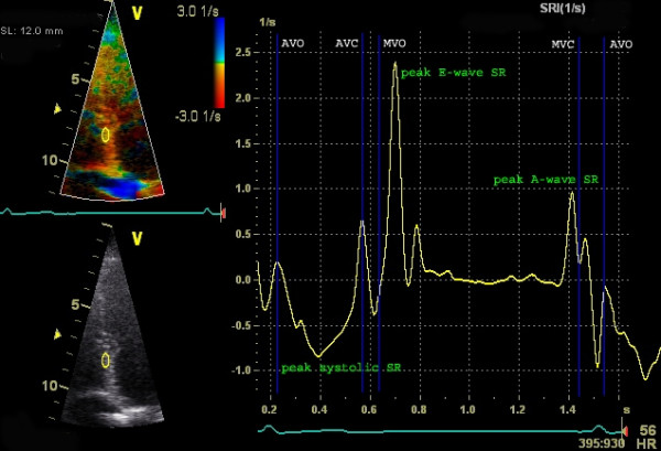 Figure 6. Mesure de la vitesse de déformation longitudinale avec le Doppler. L'axe Y représente la vitesse de déformation (1/s) et l'axe X le temps. Des valeurs négatives sont observées pendant la systole (contraction). Source