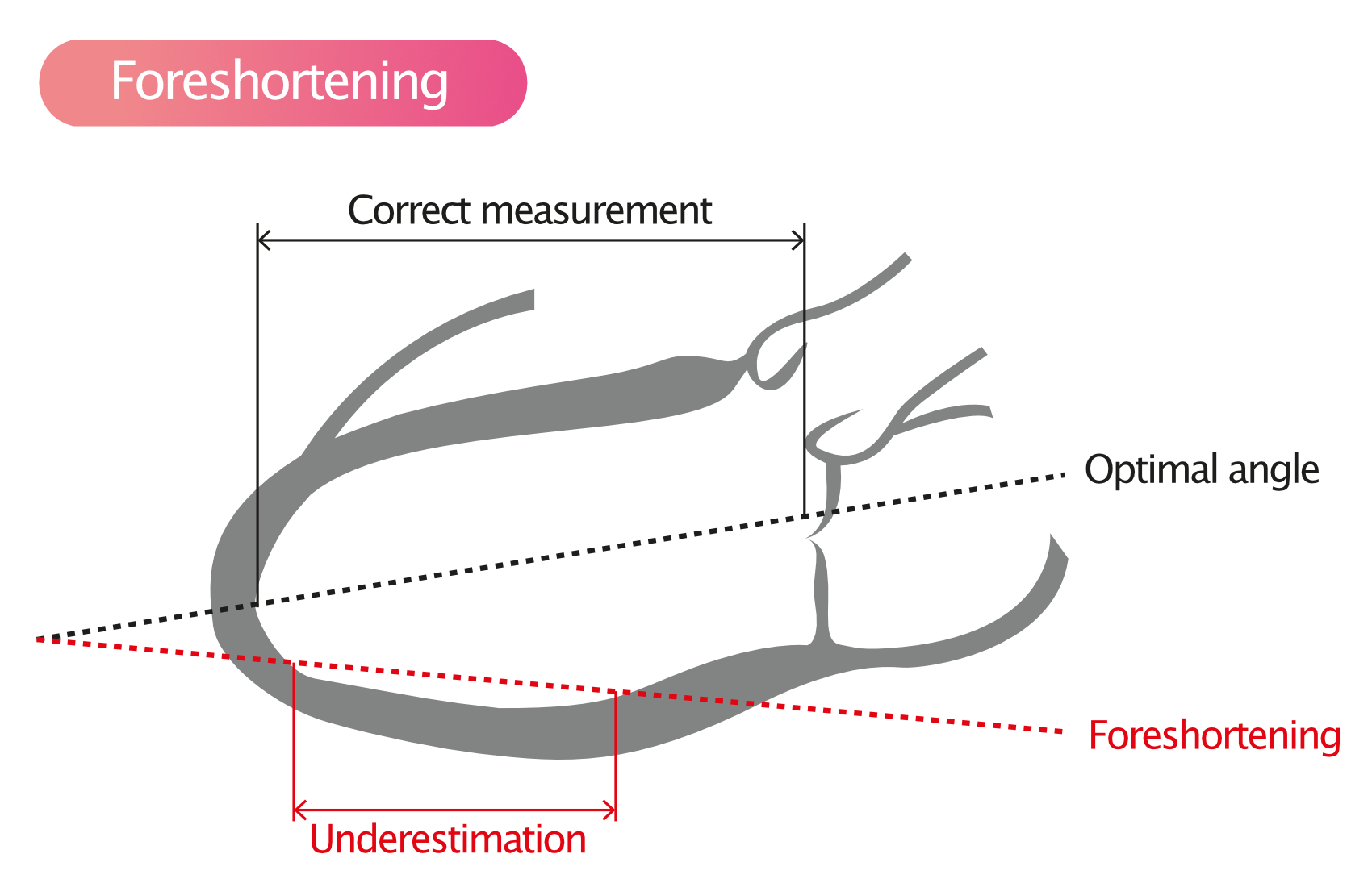 Figure 4. Raccourcissement (Foreshortening) entraînant une sous-estimation des volumes.