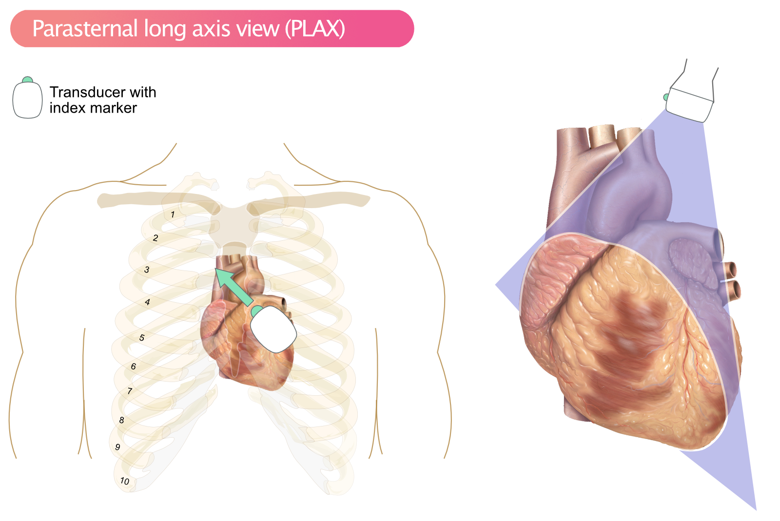 Figure 1. PLAX, vue parasternale du grand axe.