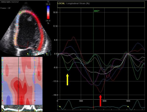 Figure 10. Vue apicale à quatre chambres (A4C) avec analyse de la déformation longitudinale. Le patient souffre d'insuffisance cardiaque avec activation asynchrone du ventricule gauche (le myocarde ventriculaire n'est pas activé de manière synchrone). Comme on peut le voir ici, les parties septales (flèche jaune et myocarde marqué en jaune) sont activées avant les parties latérales (flèche rouge et myocarde marqué en rouge). Source
