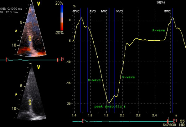 Figure 5. Examen de la déformation (déformation longitudinale) avec le Doppler tissulaire. La déformation septale est examinée. L'axe Y représente la déformation (% de déformation) et l'axe X représente le temps. Source