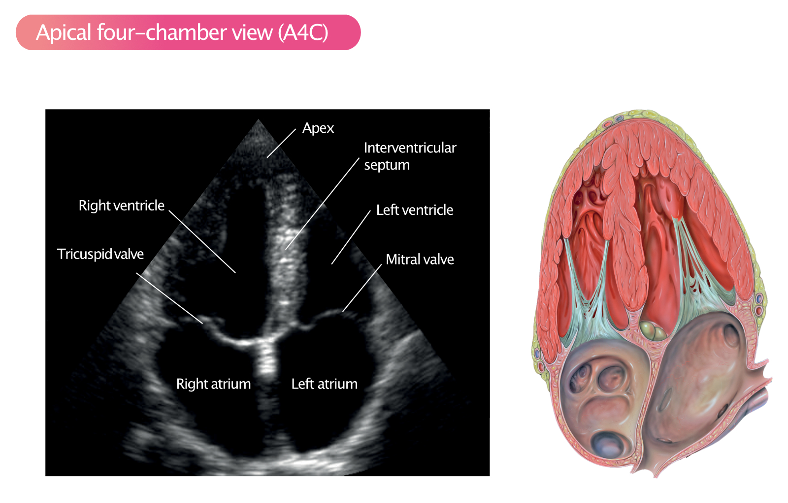 Figure 12. Vue apicale à quatre chambres (A4C).