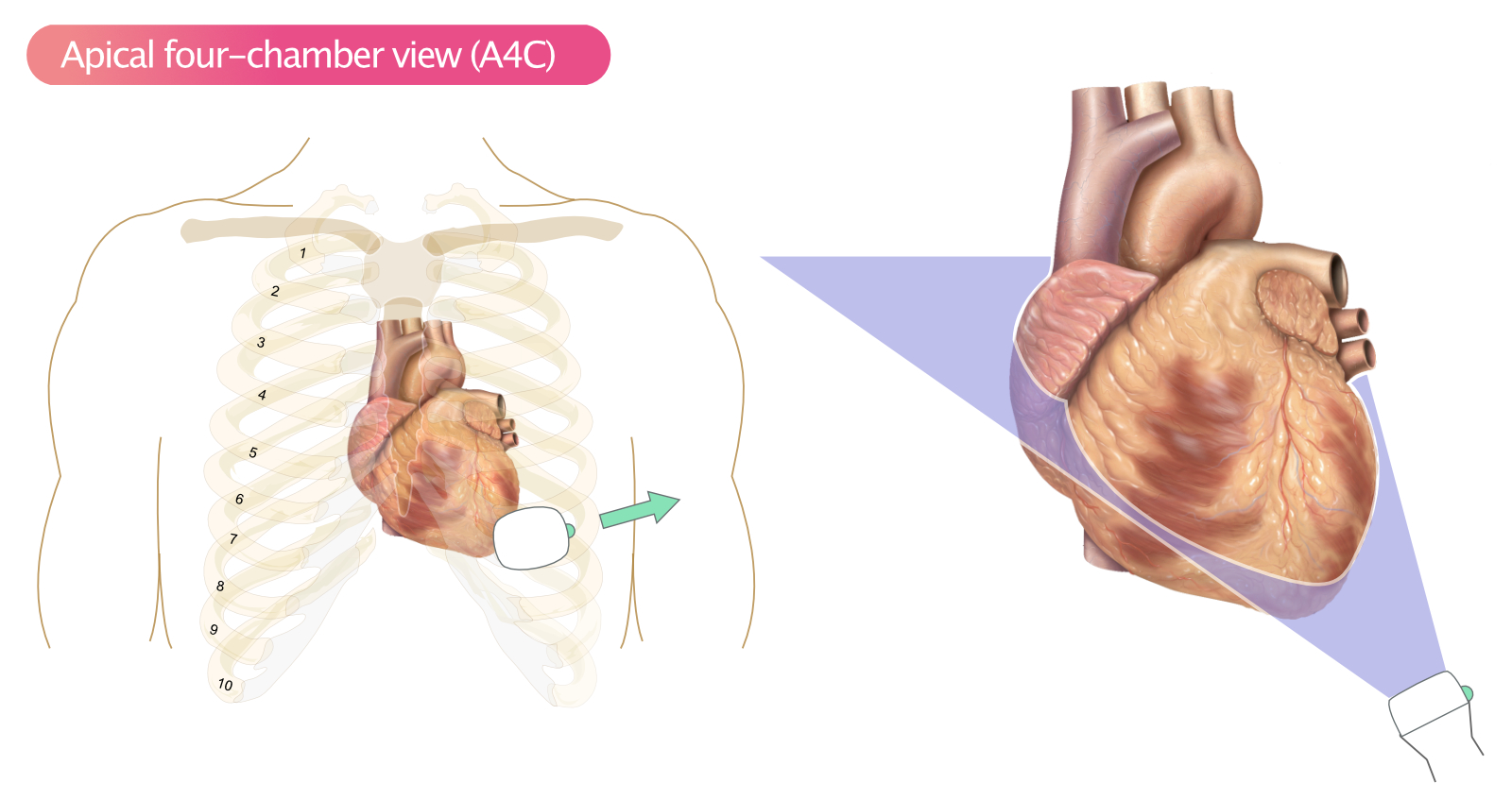 Figure 11. Vue apicale des quatre cavités (A4C).