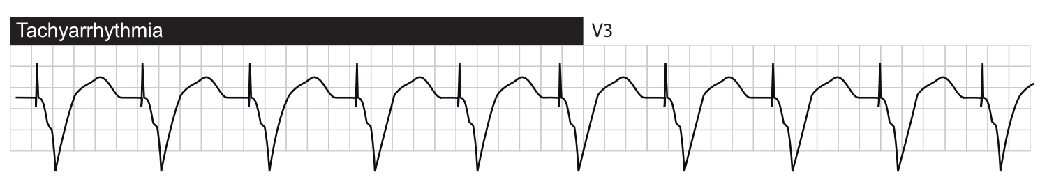 Tachyarythmie avec stimulation ventriculaire.