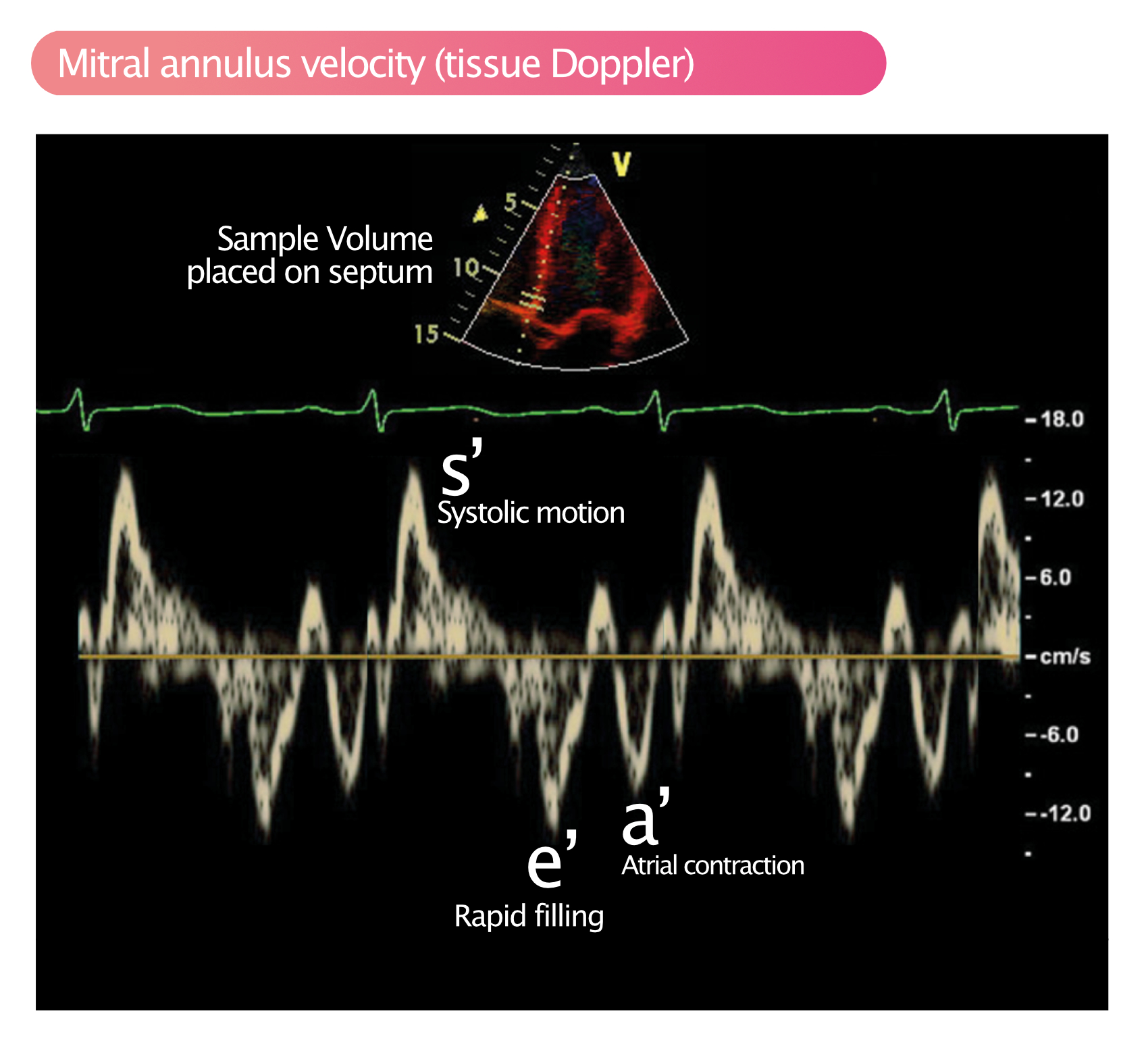 Figure 2. Doppler tissulaire pulsé analysant les mouvements de l'anneau mitral.