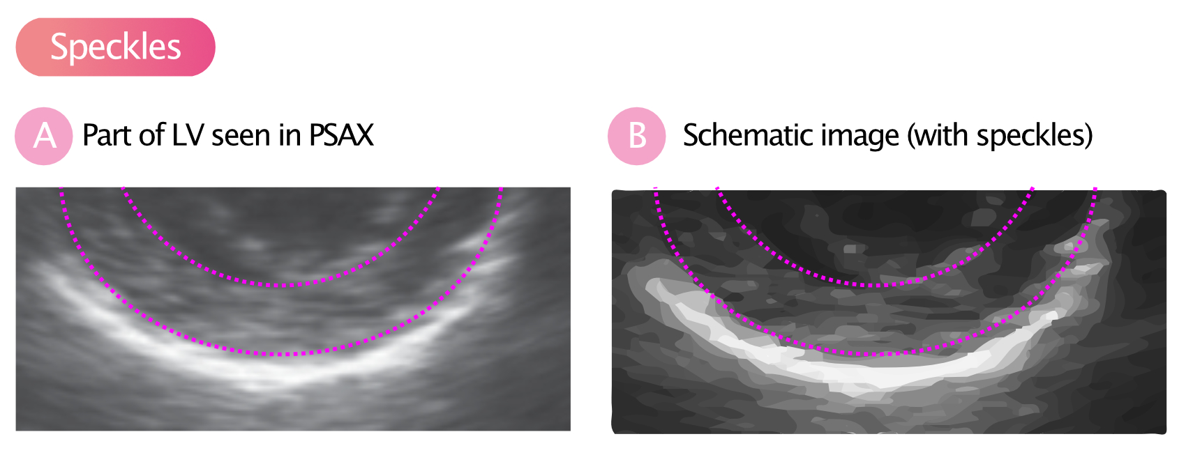 Figure 8. (A) Le myocarde est entouré de lignes en pointillés. Comme on le voit ici, le myocarde n'est pas homogène sur l'image échographique. Il apparaît structuré, en différentes nuances de gris. Ces structures sont appelées « speckles ». (B) La même image avec les speckles mis en évidence.