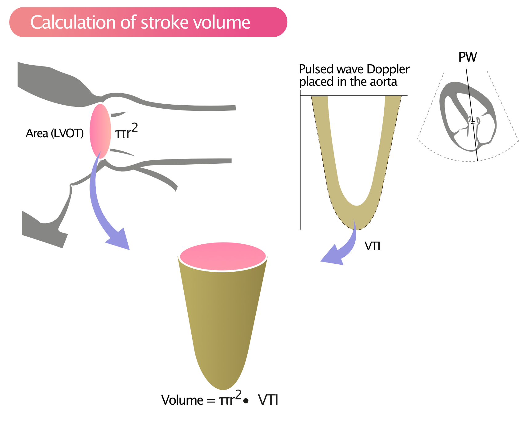 Figure 1. Calcul du volume d'éjection systolique dans la CCVG.