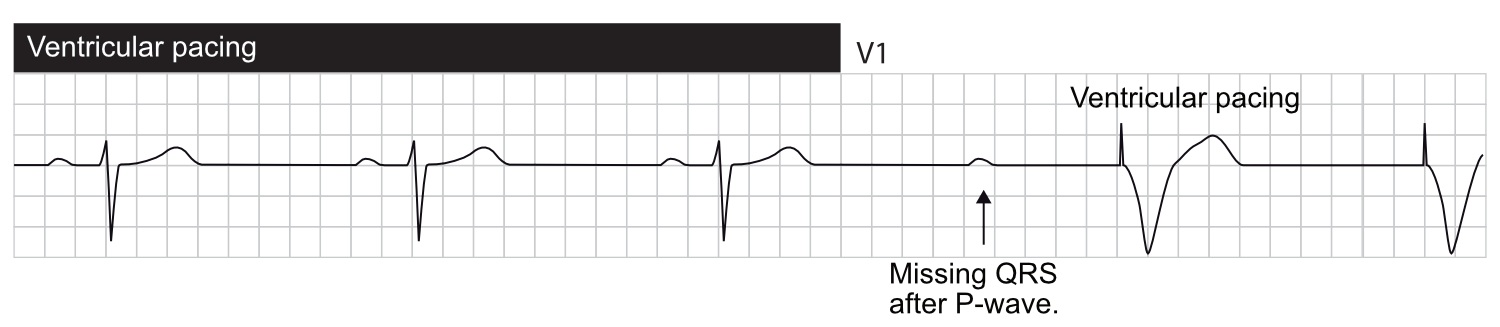 Bloc AV (onde P bloquée) entraînant une stimulation ventriculaire.