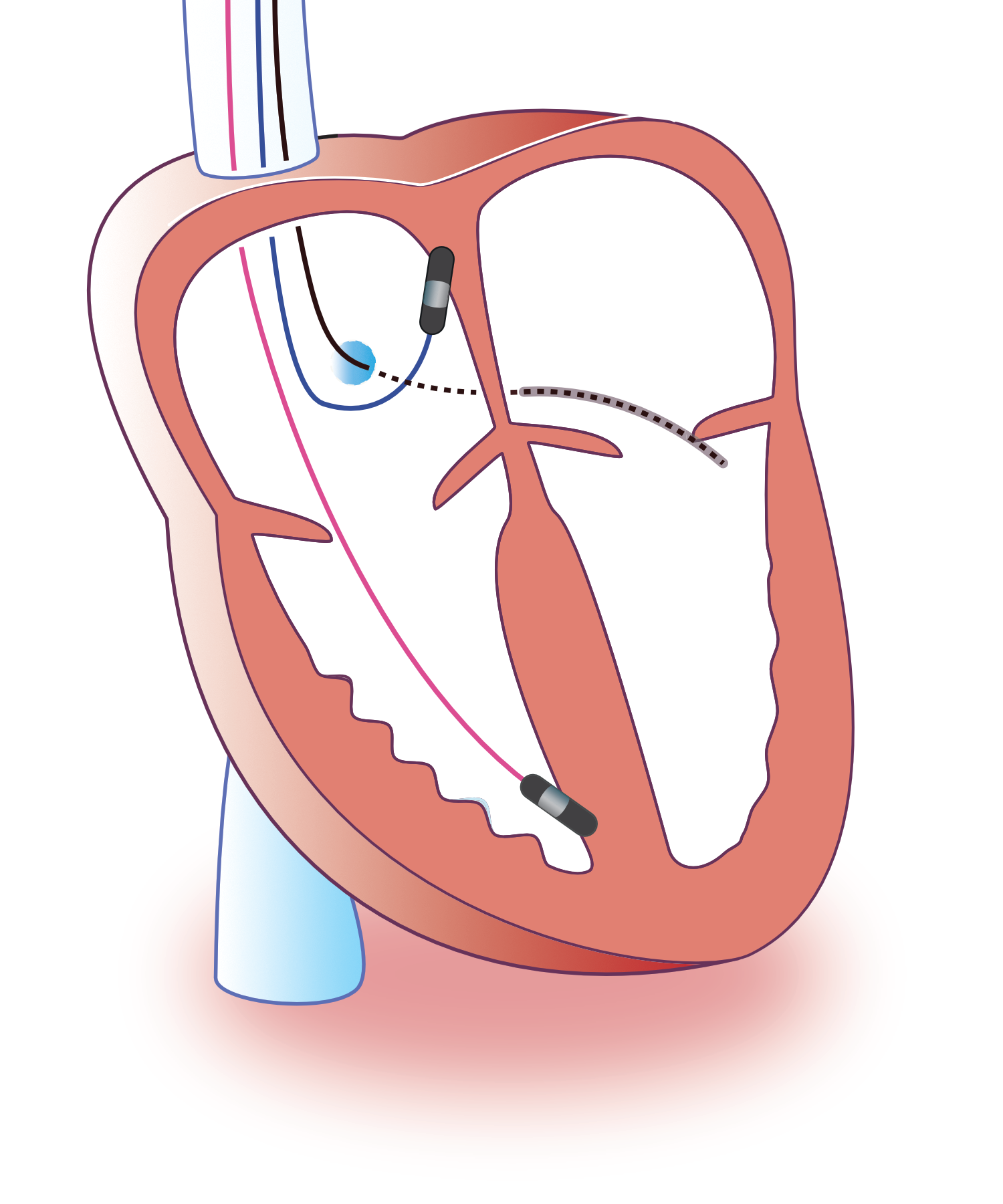 Figure 5. Thérapie de resynchronisation cardiaque (CRT)