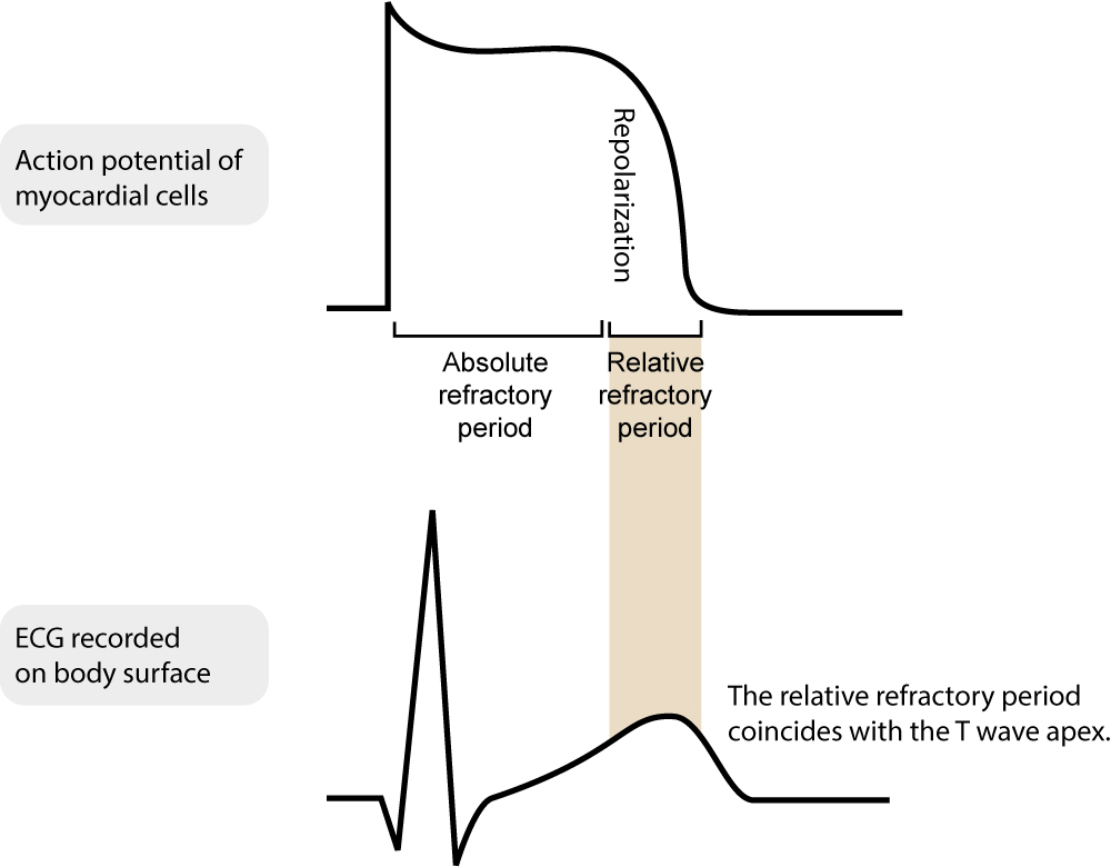 Figure 5. Périodes réfractaires absolue et relative.