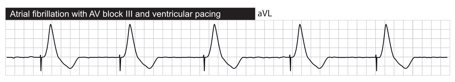 Fibrillation auriculaire avec bloc AV du troisième degré et stimulation ventriculaire.