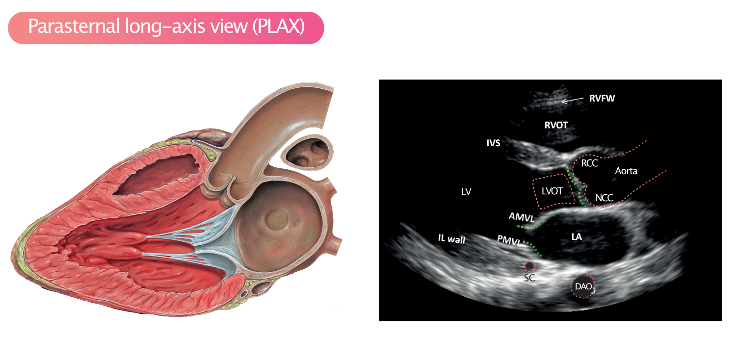Figure 3. PLAX. RVFW = paroi libre du ventricule droit ; RVOT = voie d’écoulement du ventricule droit ; RCC = cuspide coronaire droite ; NCC = cuspide non coronaire ; LA = oreillette gauche ; LV = ventricule gauche ; IL wall = paroi inféro-latérale ; IVS = septum interventriculaire (aspect antérieur) ; AMVL = feuillet antérieur de la valve mitrale ; PMVL = feuillet postérieur de la valve mitrale ; DAO = aorte descendante.
