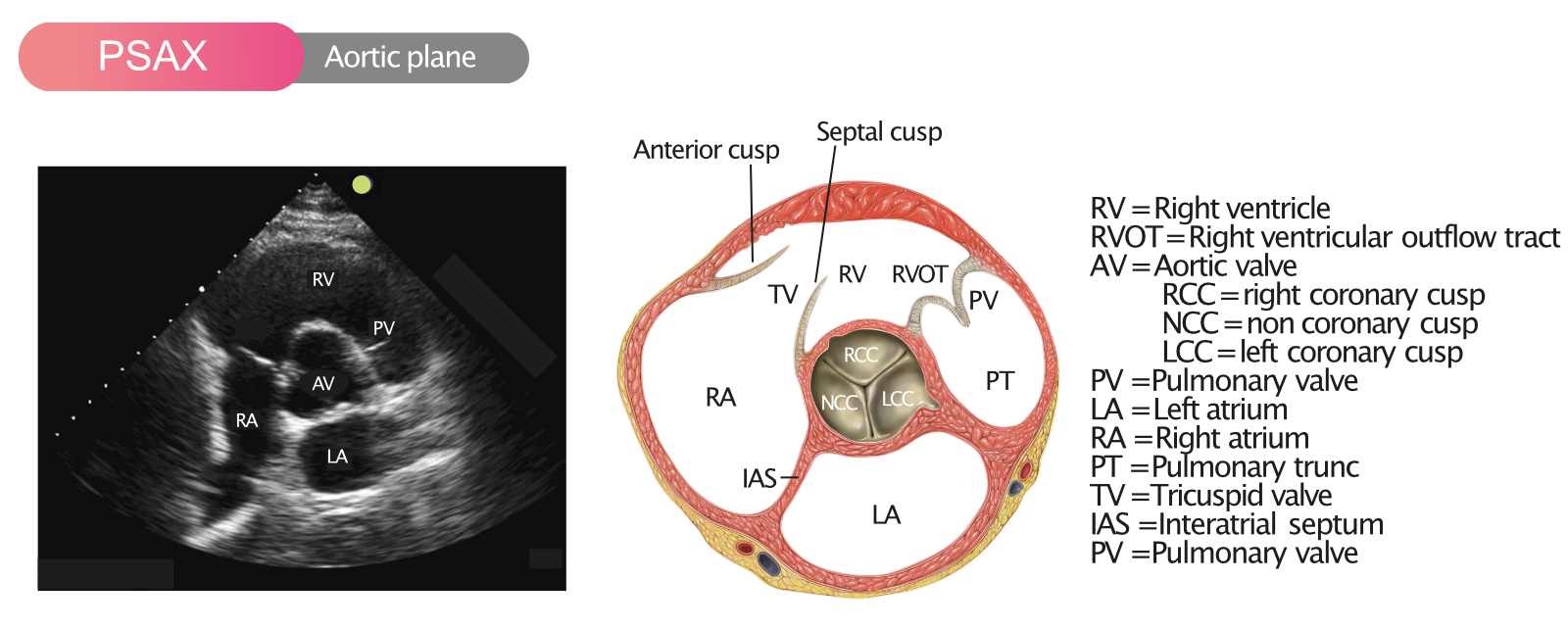 Figure 7. Vue parasternale du petit axe (PSAX) dans le plan aortique.