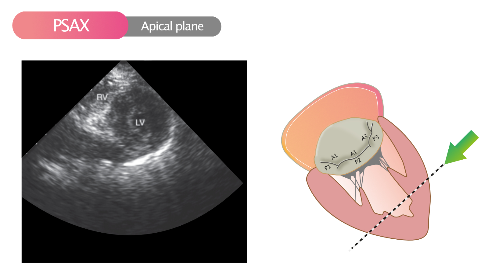 Figure 10. Vue parasternale à court axe (PSAX) dans le plan apical.