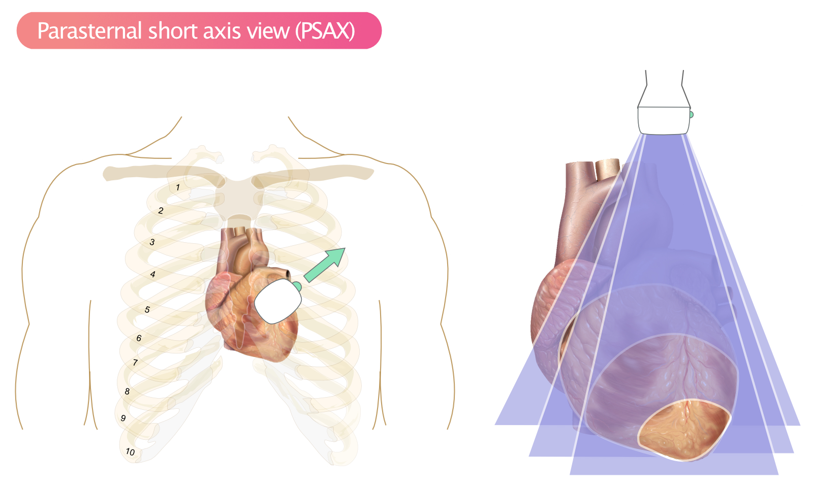 Figure 6. Vue parasternale de l’axe court (PSAX).