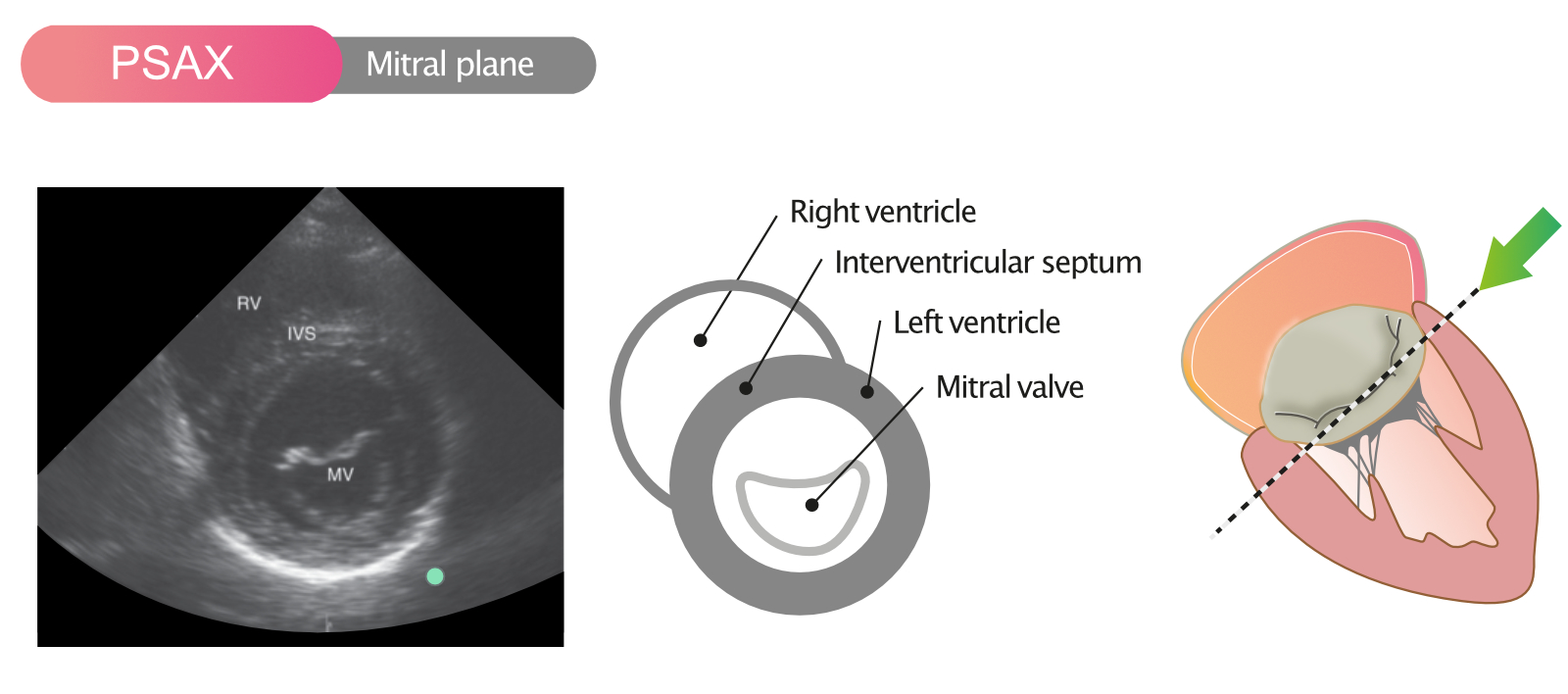 Figure 8. Vue parasternale à court axe (PSAX) dans le plan de la valve mitrale.
