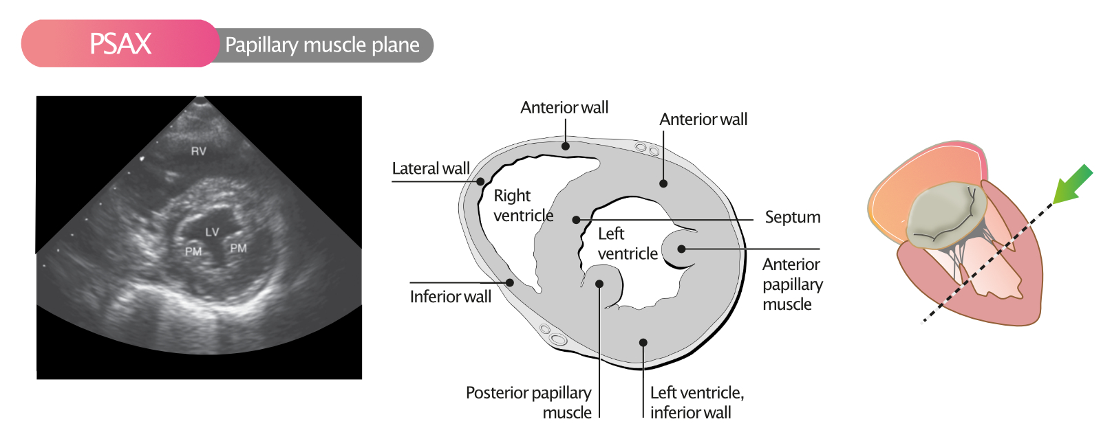 Figure 9. Vue parasternale à court axe (PSAX) dans le plan des muscles papillaires.