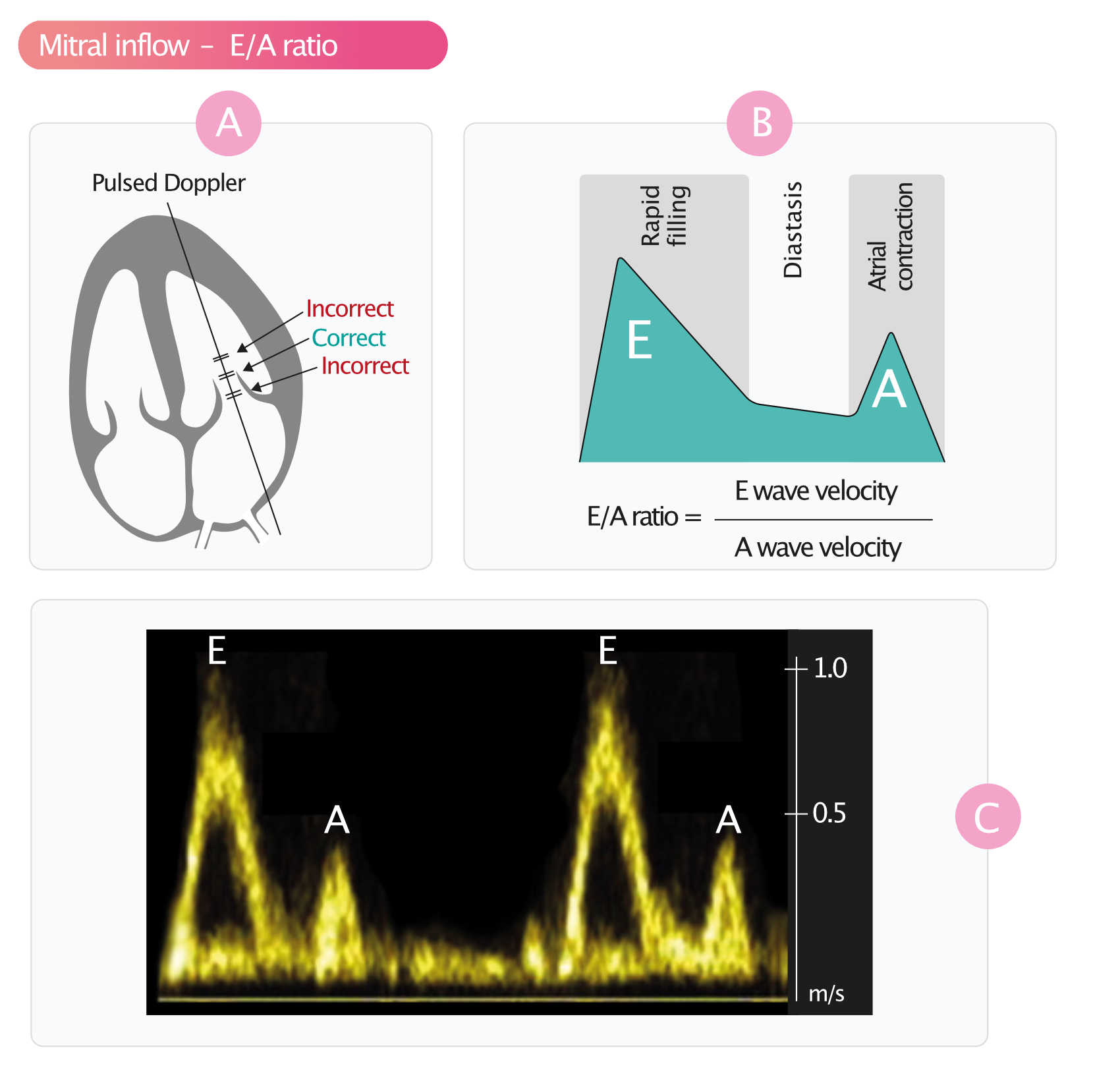 Figure 1. Mesure des vitesses de l'influx mitral.